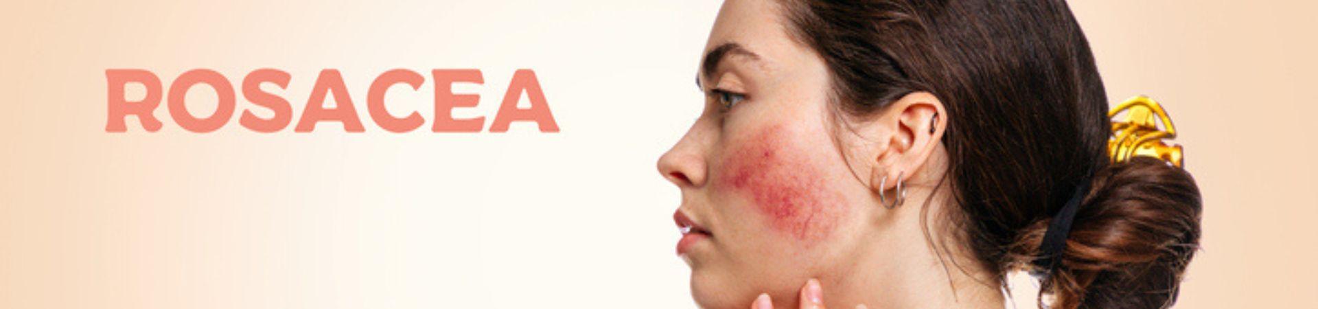 Rosacea, quanto può essere ereditaria?