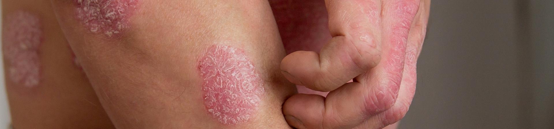 Coinvolgimento cardiovascolare e qualità di vita nella psoriasi