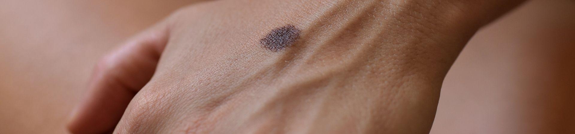 Tumori della pelle:  tra prevenzione e diffusione