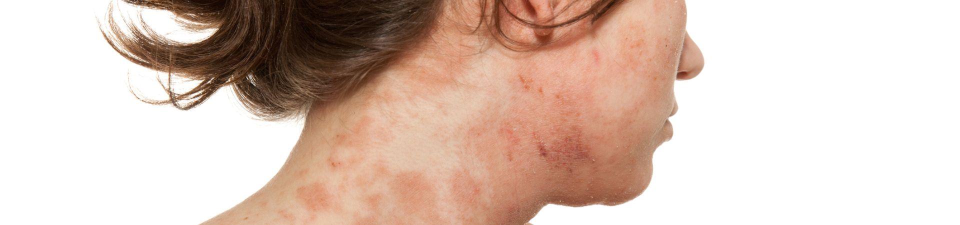 Dermatite atopica: dai bambini agli adulti