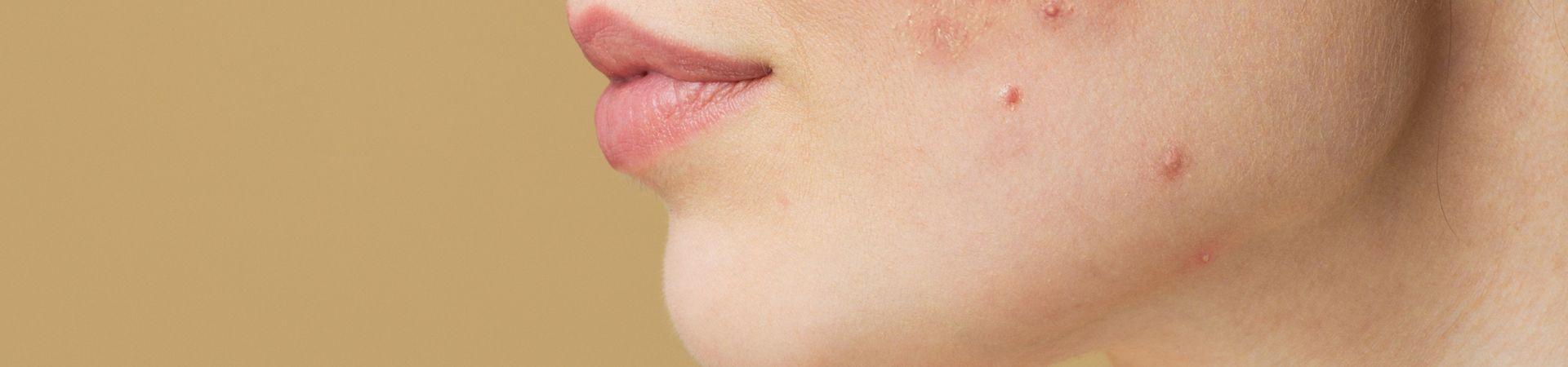 Acne e insonnia: c'è una correlazione?
