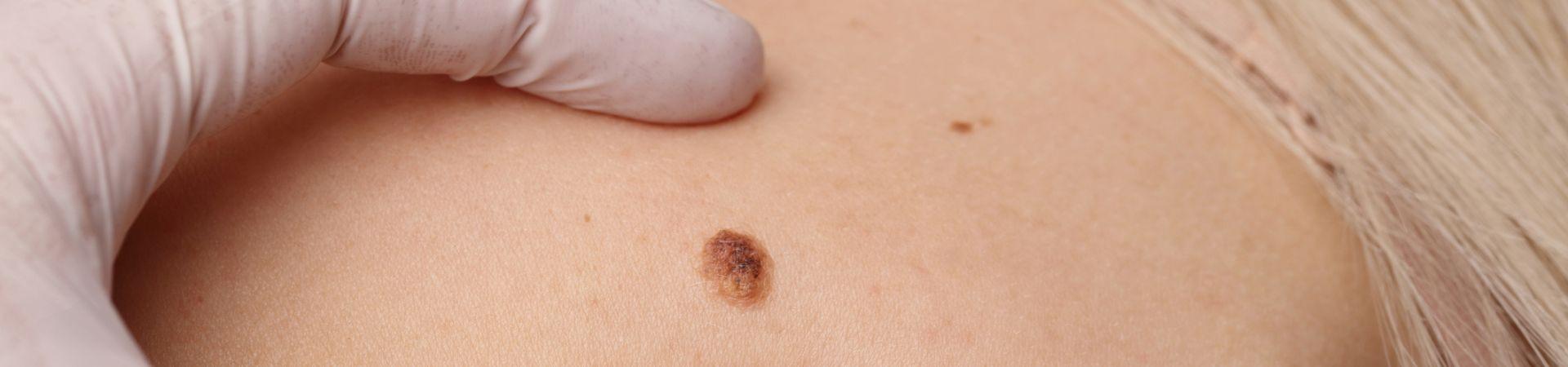 Tumori della pelle: prevenzione e diagnosi precoce
