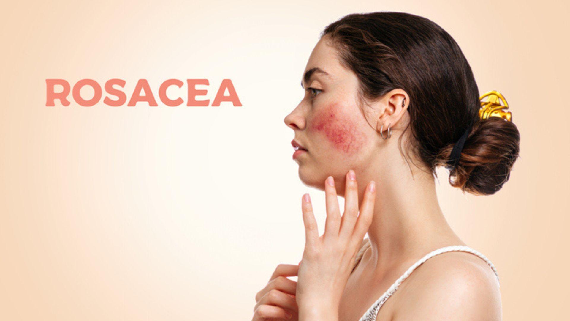 Rosacea, quanto può essere ereditaria?