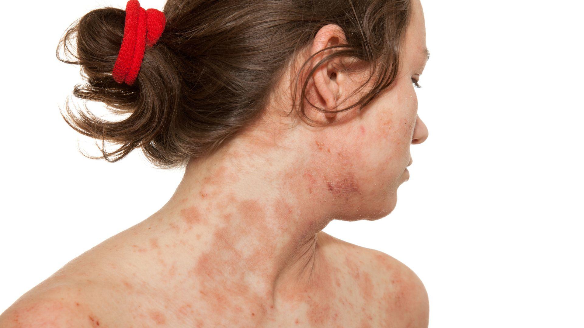 Dermatite atopica: dai bambini agli adulti