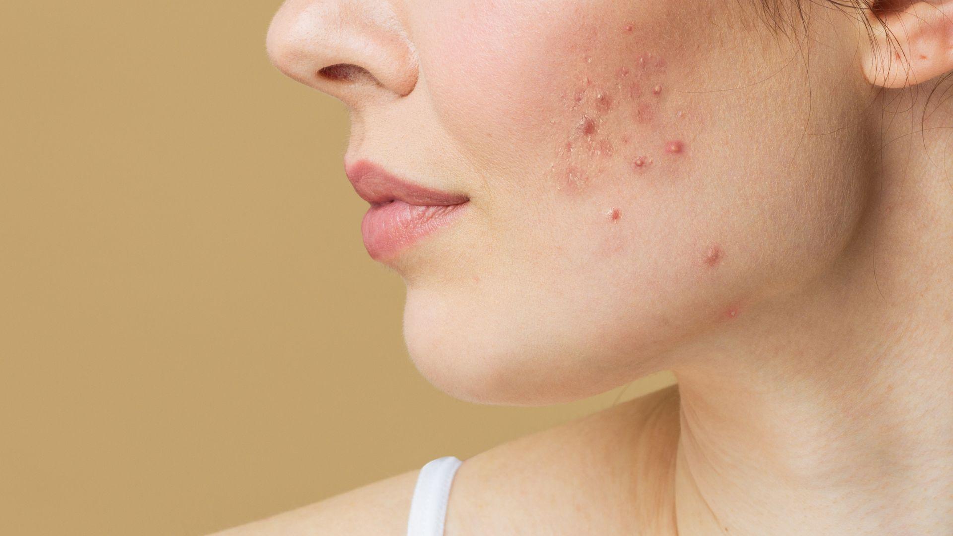 Acne e insonnia: c'è una correlazione?