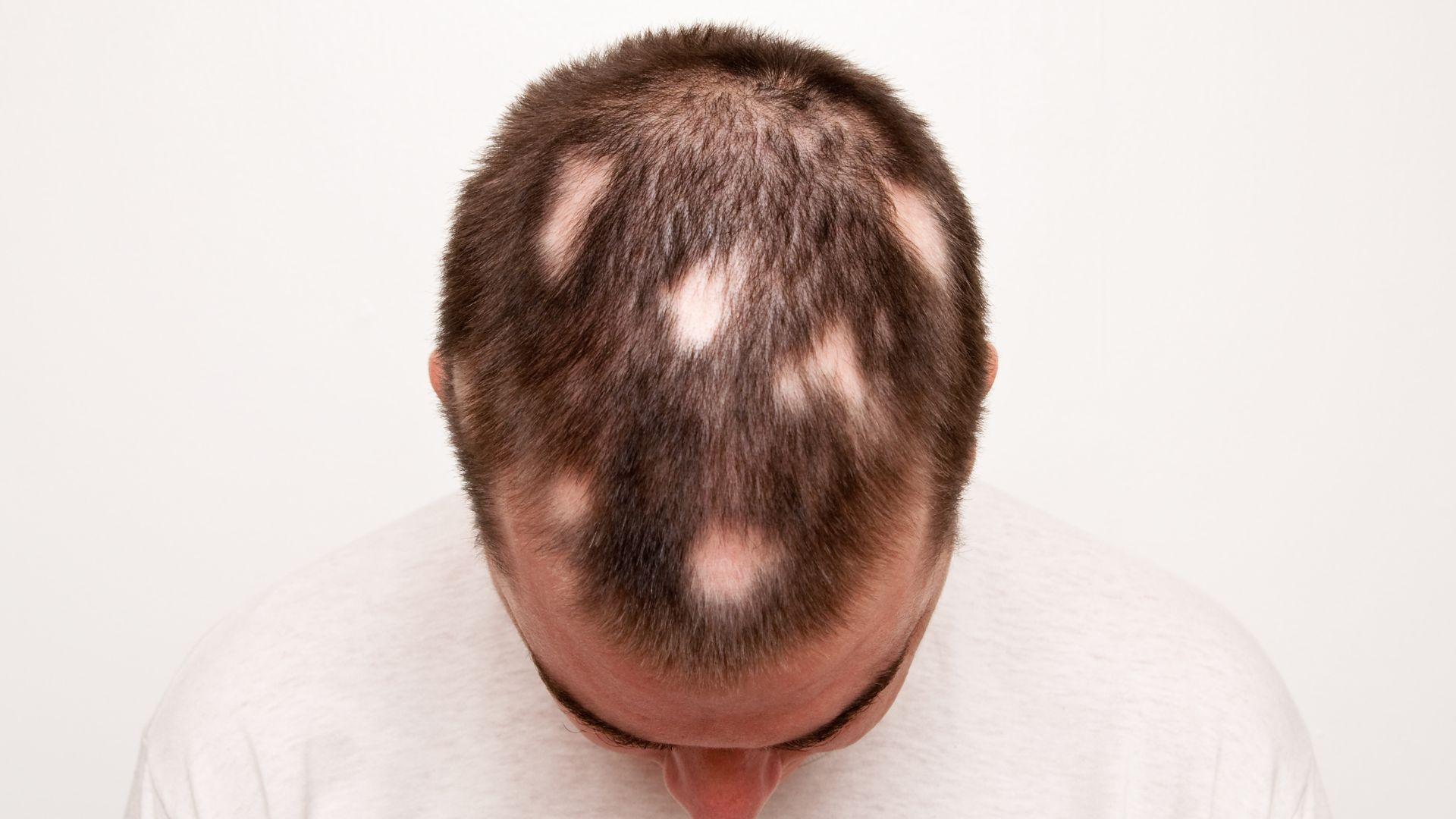 Alopecia: cause, sintomi e nuove cure