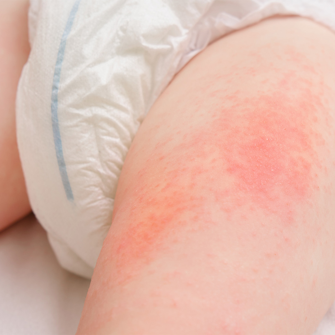 Immagine che raffigura pelle arrossata di un bambino