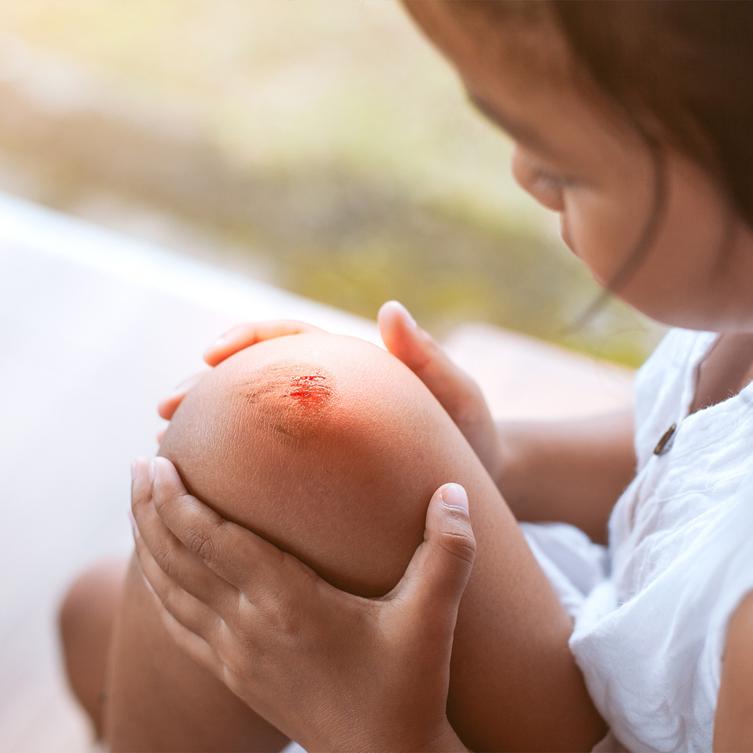 Immagine che raffigura una bambina con una ferita al ginocchio